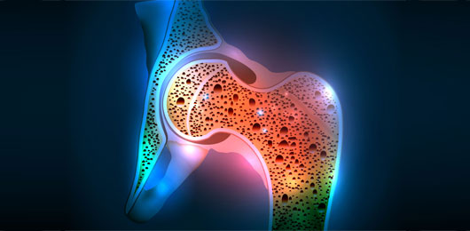 presentato Romosozumab, nuovo farmaco contro l’osteoporosi